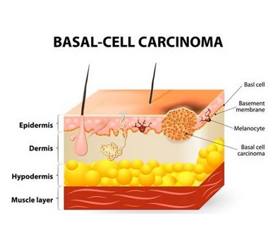 Basal Cell Cancer