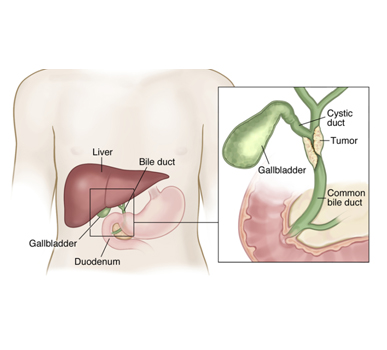 Cholangiocarcinoma or Bile Duct Cancer
