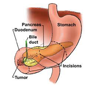 Duodenal Cancer