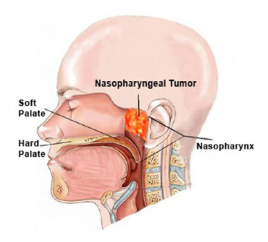 Nasopharynx Cancer